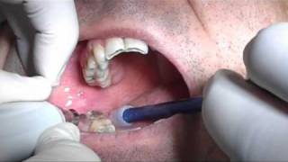 Third molars extraction without pliers and bleeding with piezosurgery in HD [upl. by Sallyann475]