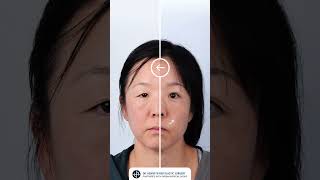 Double Eyelid Surgery Transforming Hooded Eyelids for a Brighter Youthful Look [upl. by Sierra]