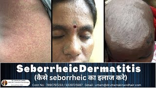 Treatment of Seborrheic Dermatitis Dandruff and Cradle Cap  कैसे डैंड्रुफ़ का इलाज करे  Dr Uttam [upl. by Amian]