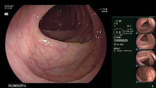 Adenoma tubular de colon oculto entre pliegues [upl. by Searcy461]