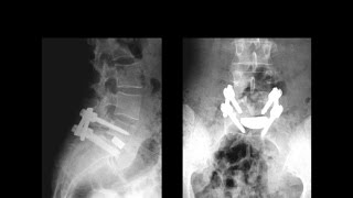 Operative Treatment of the Lytic Spondylolisthesis [upl. by Uy]