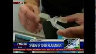 CES Acceledent News Fox 25 Boston [upl. by Ykcir]