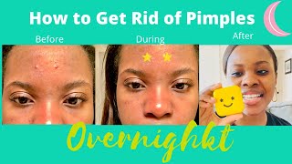 Starface Pimple Patch Review 2020⎢ How to get rid of Pimples OVERNIGHT ⎢Glow Star Refill [upl. by Myk]