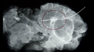 Ultrasoundguided marking of a breast lesion [upl. by Maurene]