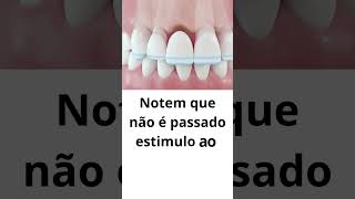 PRÓTESE FIXA OU IMPLANTE DENTÁRIO [upl. by Nuahsyt]