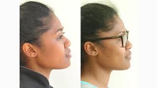 How Orthodontic Extractions can change Facial Profiles [upl. by Eves386]