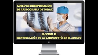 CURSO DE INTERPRETACIÓN DE LA RADIOGRAFÍA TORÁCICA IDENTIFICACIÓN DE CARDIOPATÍAS [upl. by Thorrlow]