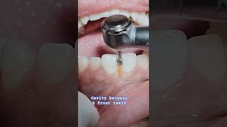 Cavities between front teeth viral smile fashion veneers youtubeshorts composite bondingasmr [upl. by Honeywell383]