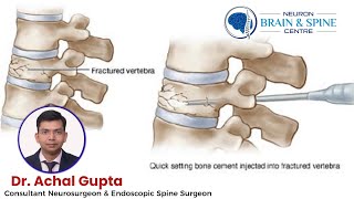 Percutaneous Vertebroplasty  Dr Achal Gupta  Consultant Neurosurgeon amp Endoscopic Spine Surgeon [upl. by Nwonknu]