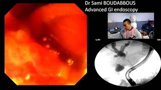 ERCP for Hiliary neoplasic stricture [upl. by Newol]