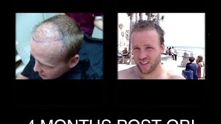 4 FUE Hair Transplant Mexico with Dr Nader in Reynosa 4 month post OP [upl. by Liek119]