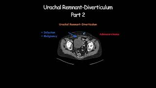 Urachal RemnantDiverticulum Part 2 radiology radiologist embryology urinarybladder [upl. by Oiramaj]