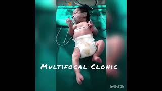 Neonatal Seizures  Vatsalya Shishu Hospital Ajmer  NICU  Neonatologist [upl. by Leschen]