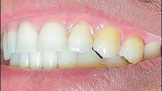 Dental Crown Cementation Procedure turn on the subtitles GreatTeeth [upl. by Hgielah288]