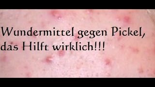 Mein Wundermittel gegen Pickel  Das hilft wirklich bei Akne  Pickel weg über Nacht [upl. by Feetal]