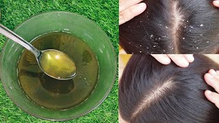 Best oil for dandruff and hairfall control  Hair oil for dandruff and itchy scalp  Dandruff oil [upl. by Ahsima923]