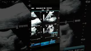 Fetal Movements  Biophysical Profile Live Ultrasound [upl. by Columbyne581]