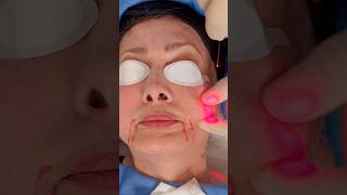 Endolift Jowls Treatment PCH MedSpa Los Angeles [upl. by Frantz499]