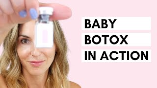 Baby Botox  Using a Dermastamp for Microneedling [upl. by Roselle250]