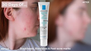 30 DAYS OF La RochePosay Effaclar Duo for Blemishes Blackheads amp PostAcne Marks One Month Review [upl. by Quillon42]