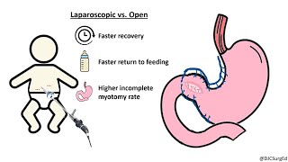 Hypertrophic Pyloric Stenosis [upl. by Aihpledalihp]