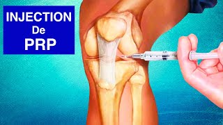 ARTHROSE DU GENOU  Injection de PRP Plasma riche en plaquettes [upl. by Eilrebmik]