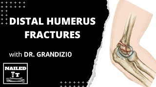 Distal Humerus Fractures w Dr Grandizio [upl. by Yusuk]