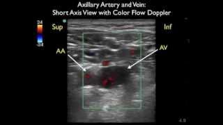 How To Axillary Vein Cannulation  Sonosite Ultrasoundmp4 [upl. by Yentroc349]