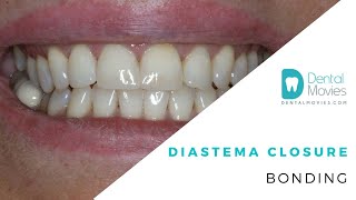 Diastema closure  bonding 🦷 [upl. by Iaw]