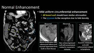 The Normal Small Bowel [upl. by Omsoc]