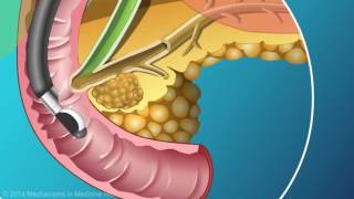 Pancreas US Endoscopy amp biopsy [upl. by Ceciley14]