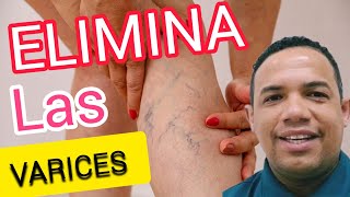 MEDICAMENTO PARA ELIMINAR LAS VARICES Y ESTRÍAS [upl. by Dulcine864]